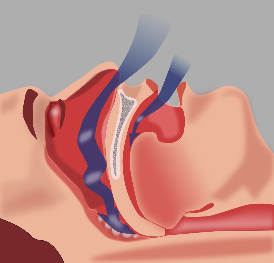 Diagram perbandingan jalan napas terbuka dan tersumbat saat tidur